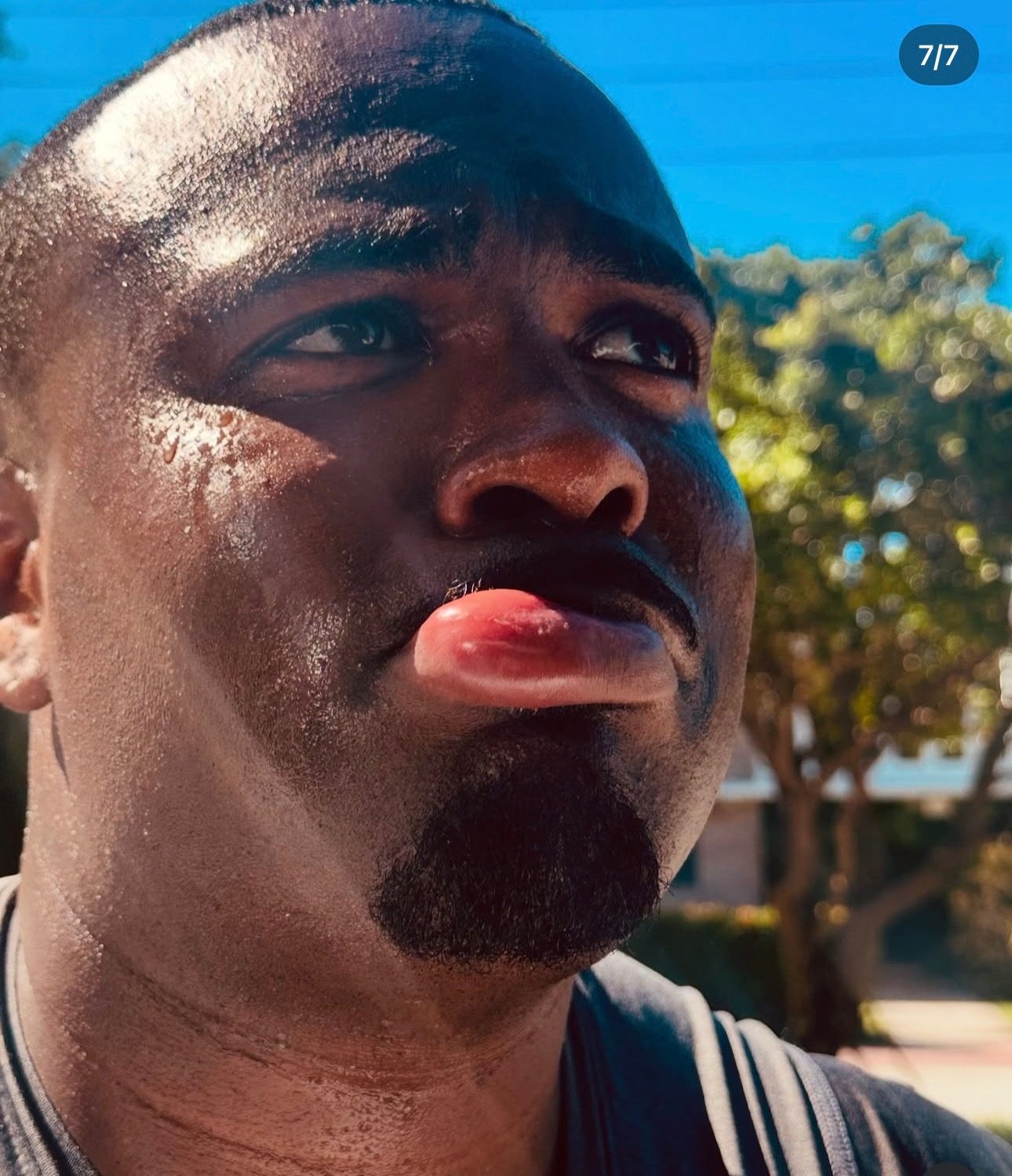 Professional beekeeper showing reaction to bee sting on lip, illustrating why DIY bee removal is dangerous
